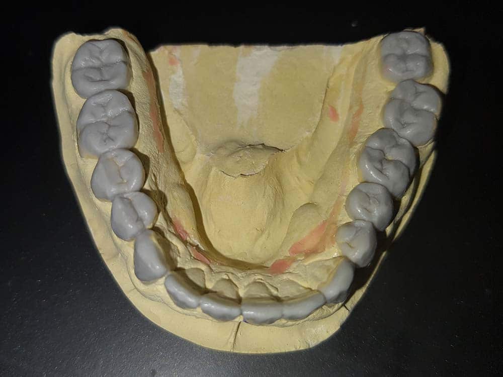 wax-up, czyli symulacja w wosku nowego kształtu i wysokości zębów dolnych