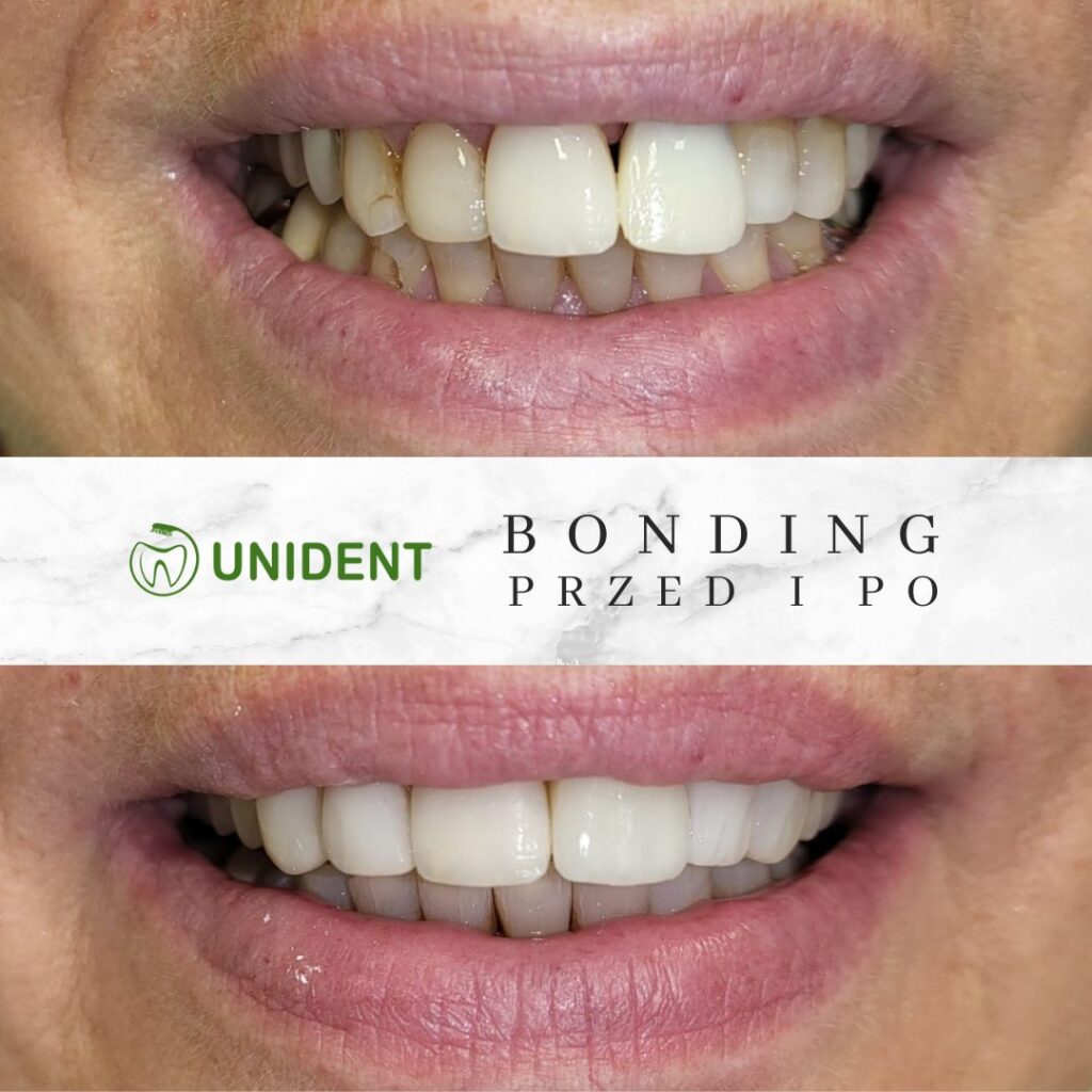 Bonding wykonany w Unident w Szczecinie zdjęcie uzębienia przed i po zabiegu bondingu