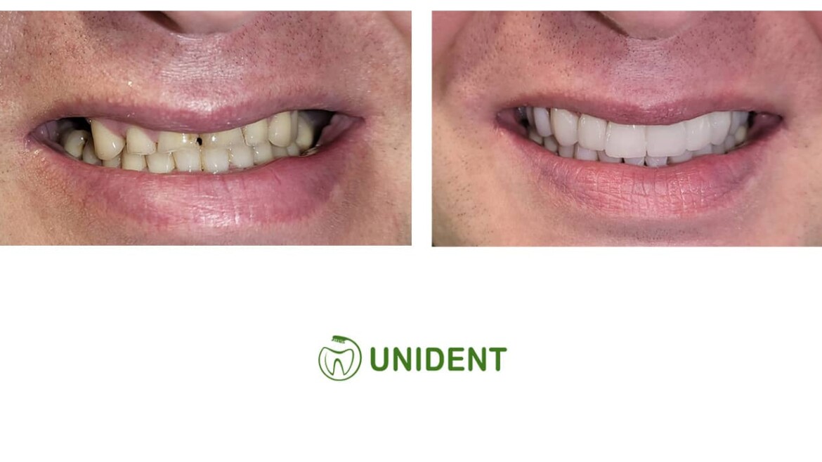 Leczenie nadmiernie startych zębów