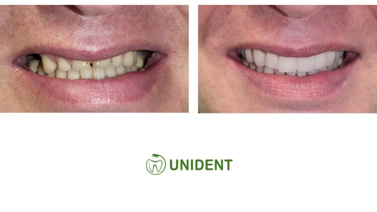 Leczenie nadmiernie startych zębów