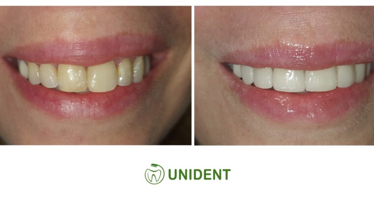 Licówki porcelanowe