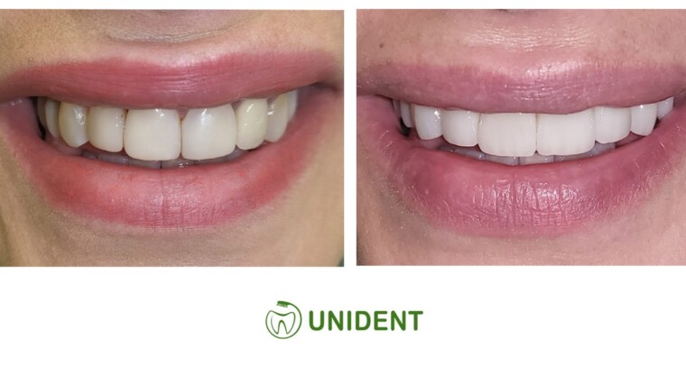 Licówki porcelanowe szczecin