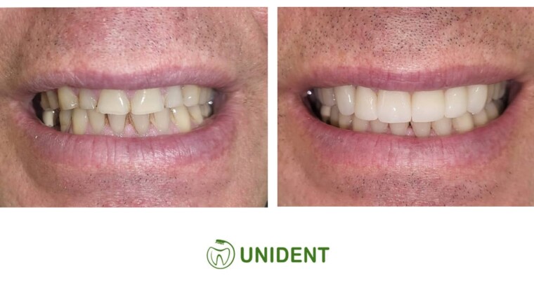 Starte zęby przed i po leczeniu w Unident w Szczecinie
