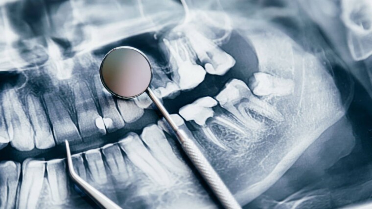 RTG zębów
