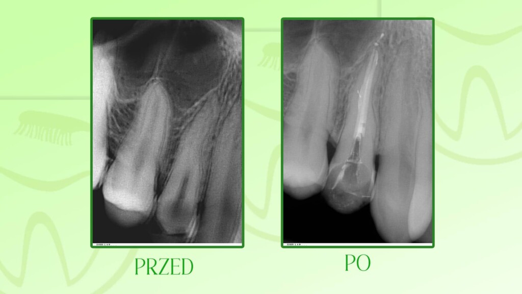 Leczenie kanałowe zęba w Szczecinie