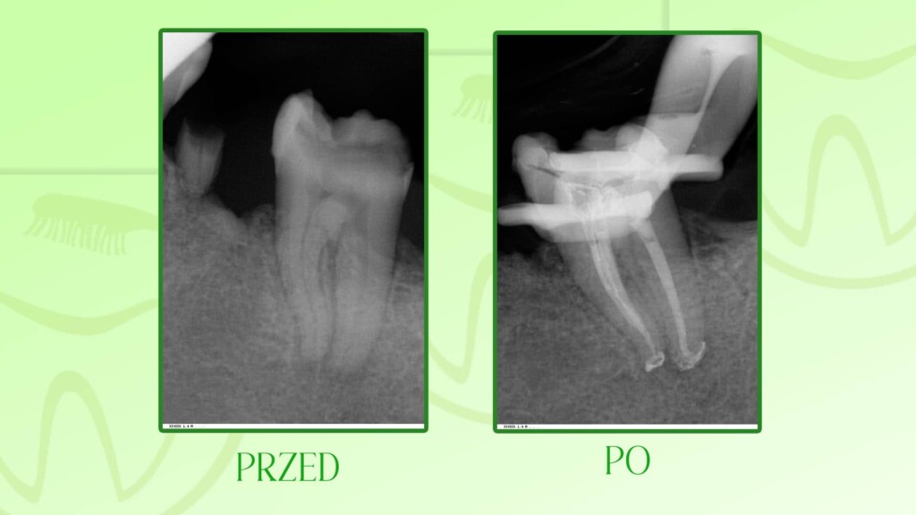 Leczenie kanałowe zęba w Szczecinie przed i po