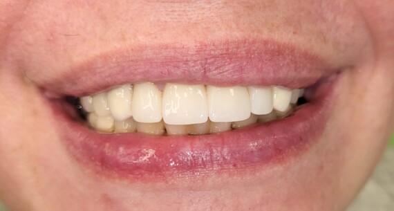 Protezy na zatrzaskach Szczecin – bez klamer, na własnych zębach