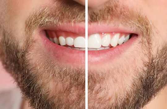 Gingivoosteoplastyka w Szczecinie – precyzyjna korekta dziąsła i kości dla zdrowia i estetyki uśmiechu