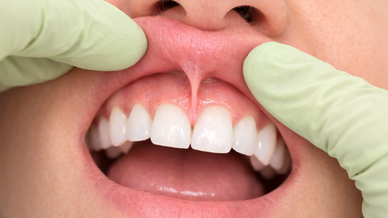 Wędzidełko – czym jest i kiedy wymaga leczenia?