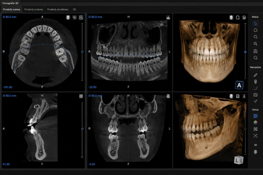 Tomografia zębów CBCT 3D – diagnostyka stomatologiczna Unident Szczecin